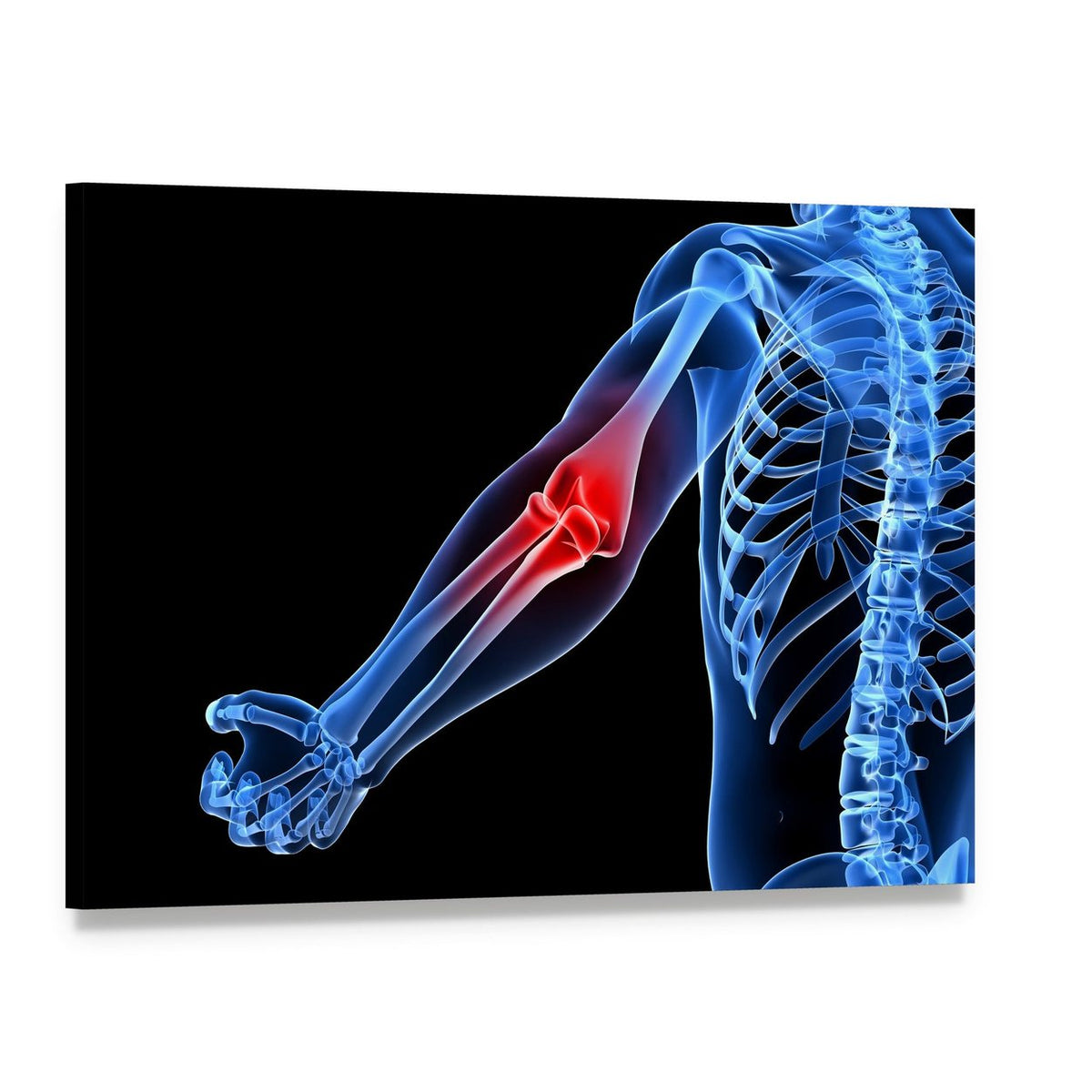 Painful Elbow Medical Illustration Canvas Wall Art, single panel gallery wrapped canvas, angled product view