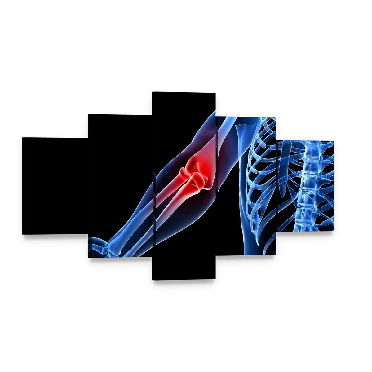 Painful Elbow Medical Illustration Canvas Wall Art, 5 panel 5 Star layout gallery wrapped canvas set, angled product view