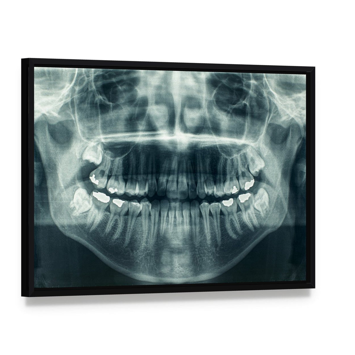 Dental X-ray Canvas Wall Art, framed canvas in a black floater frame, angled product view