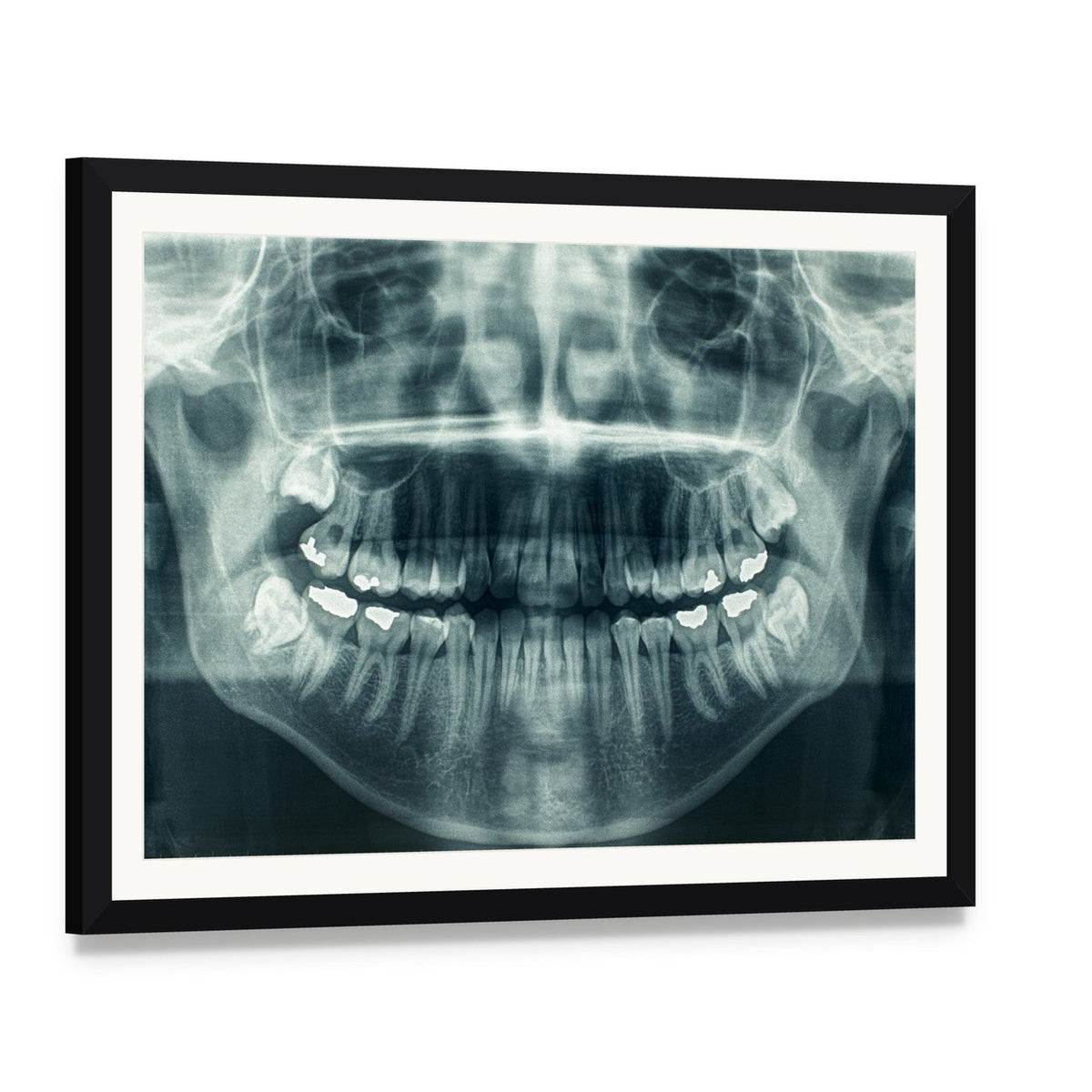 Dental X-ray Canvas Wall Art, framed print with white mat and black frame, angled product view