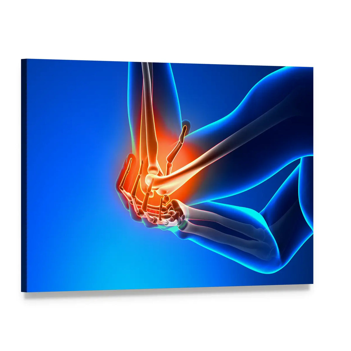 Elbow Joint Pain Illustration Canvas Wall Art, single panel gallery wrapped canvas, angled product view