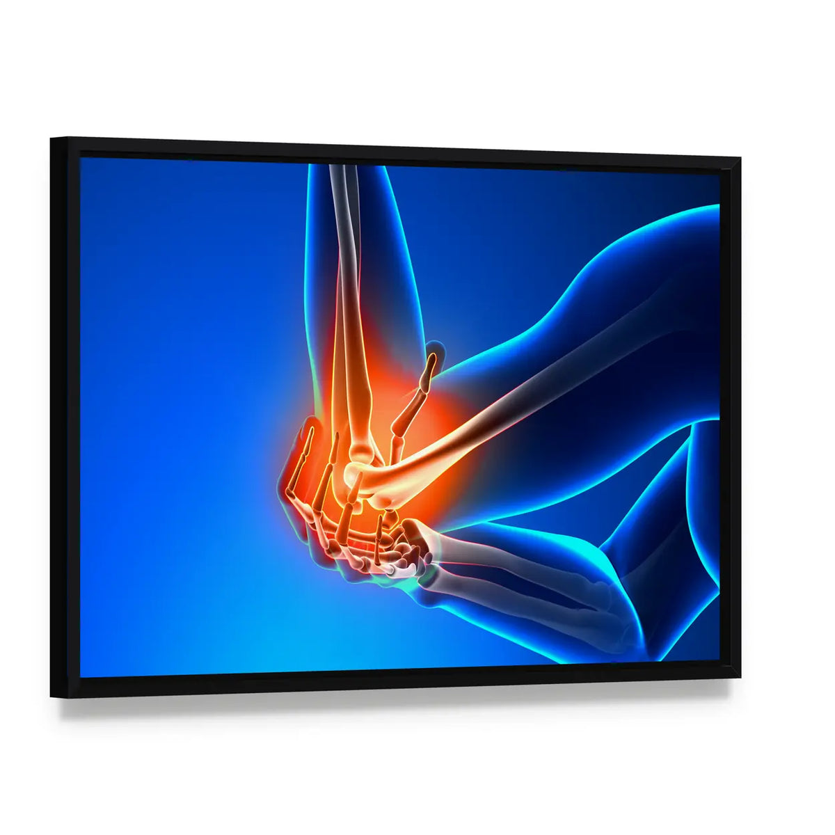 Elbow Joint Pain Illustration Canvas Wall Art, framed canvas in a black floater frame, angled product view