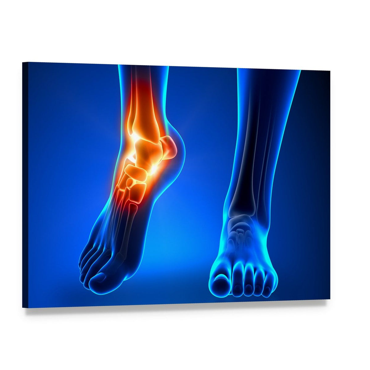 Inflamed Left Ankle Illustration Canvas Wall Art, single panel gallery wrapped canvas, angled product view