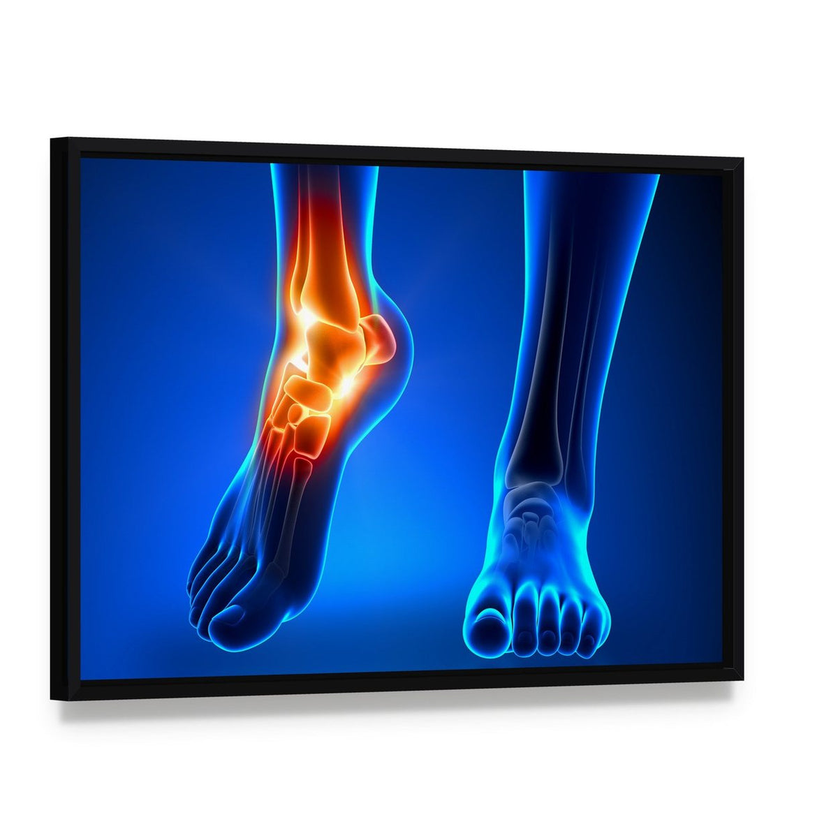 Inflamed Left Ankle Illustration Canvas Wall Art, framed canvas in a black floater frame, angled product view