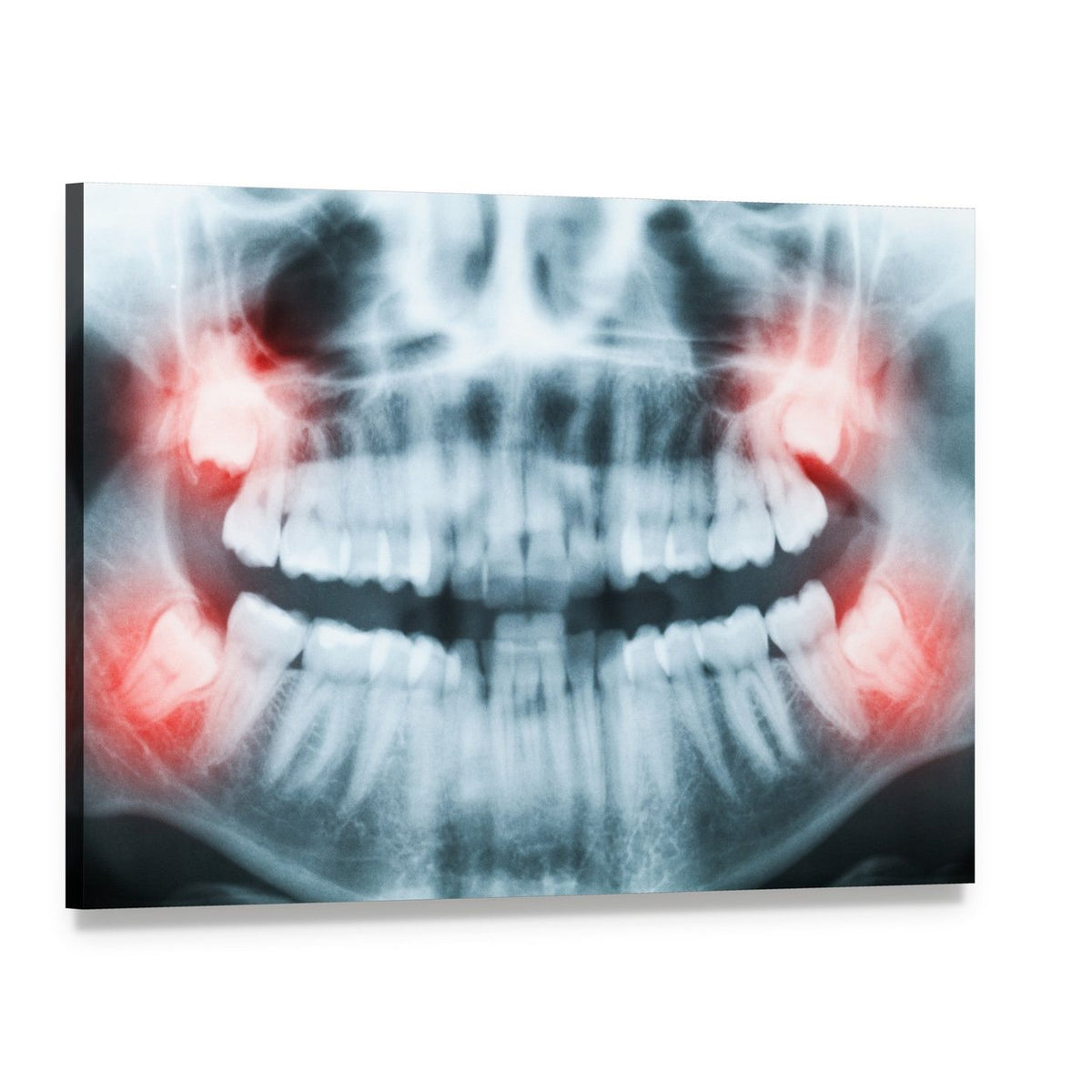 Dental X-ray of Jaw and Wisdom Teeth Canvas Wall Art, single panel gallery wrapped canvas, angled product view