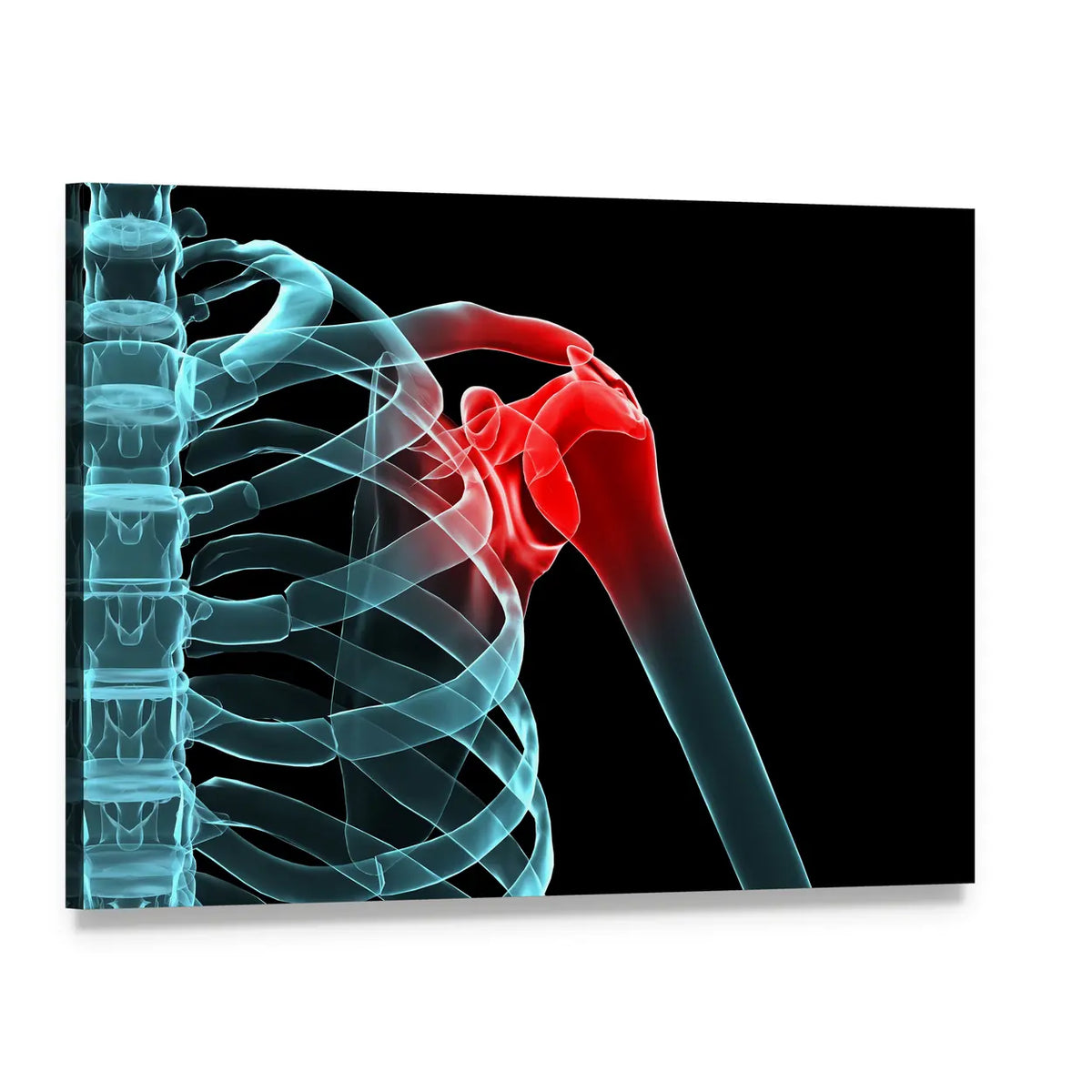 Painful Shoulder X-ray Canvas Wall Art, single panel gallery wrapped canvas, angled product view