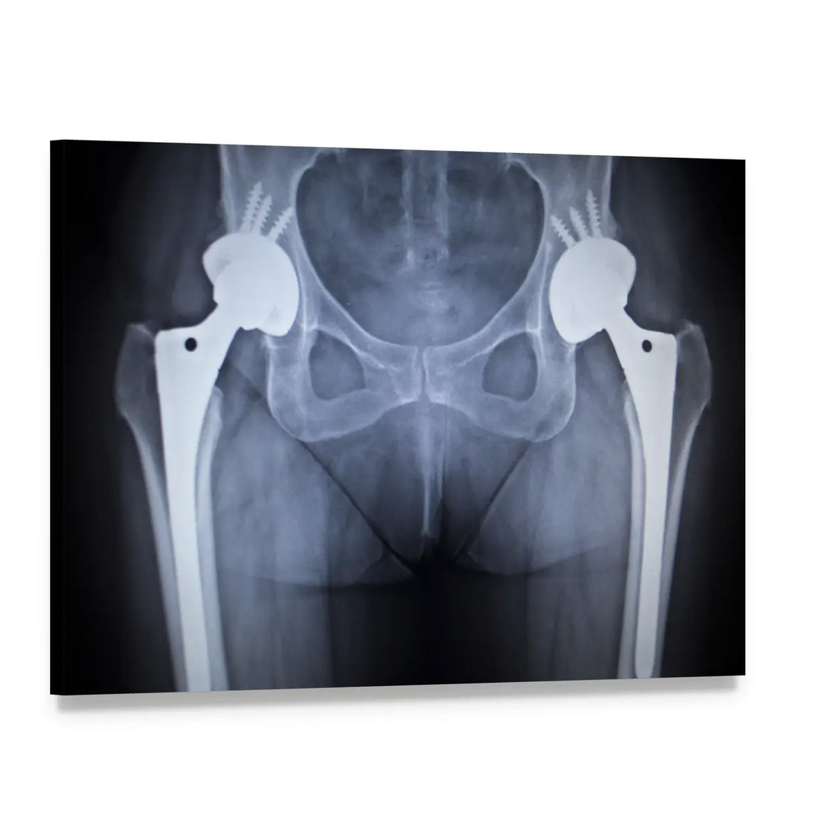 Hip Joint X-ray Scan Canvas Wall Art, single panel gallery wrapped canvas, angled product view