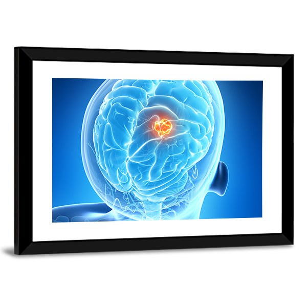 Glowing Brain Tumor Illustration Canvas Wall Art