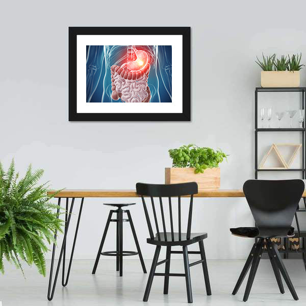 Painful Stomach Anatomical Illustration Canvas Wall Art