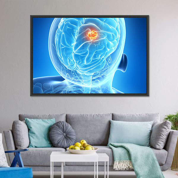 Glowing Brain Tumor Illustration Canvas Wall Art