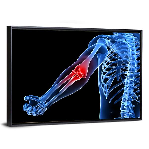 Painful Elbow Illustration Canvas Wall Art-5 Horizontal-Gallery Wrap-22" x 12"-Tiaracle