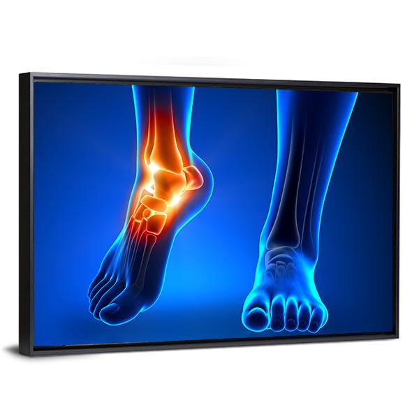 Ankle Pain Detail Canvas Wall Art-5 Horizontal-Gallery Wrap-22" x 12"-Tiaracle
