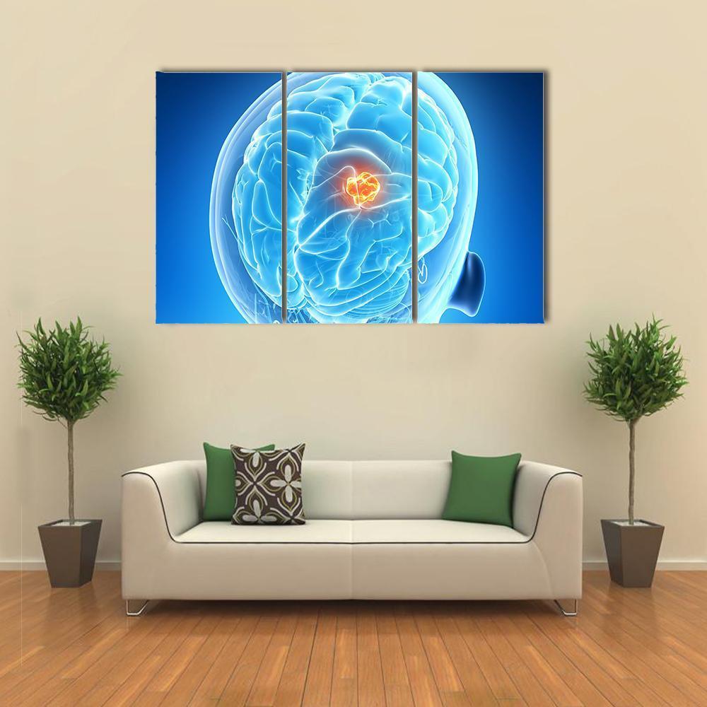 Brain Tumor Illustration Canvas Wall Art-3 Horizontal-Gallery Wrap-37" x 24"-Tiaracle