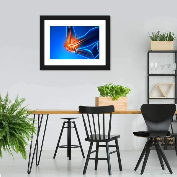 Elbow Pain Illustration Canvas Wall Art-3 Horizontal-Gallery Wrap-25" x 16"-Tiaracle