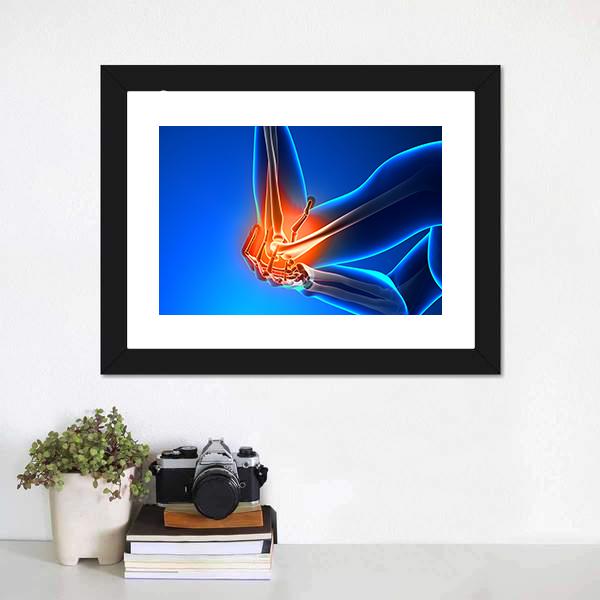 Elbow Pain Illustration Vertical Canvas Wall Art-3 Vertical-Gallery Wrap-12" x 25"-Tiaracle