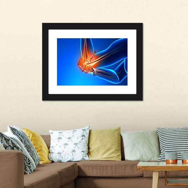 Elbow Pain Illustration Vertical Canvas Wall Art-3 Vertical-Gallery Wrap-12" x 25"-Tiaracle