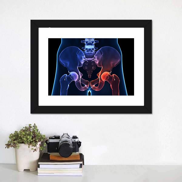Human Painful Hip Canvas Wall Art-1 Piece-Framed Print-20" x 16"-Tiaracle