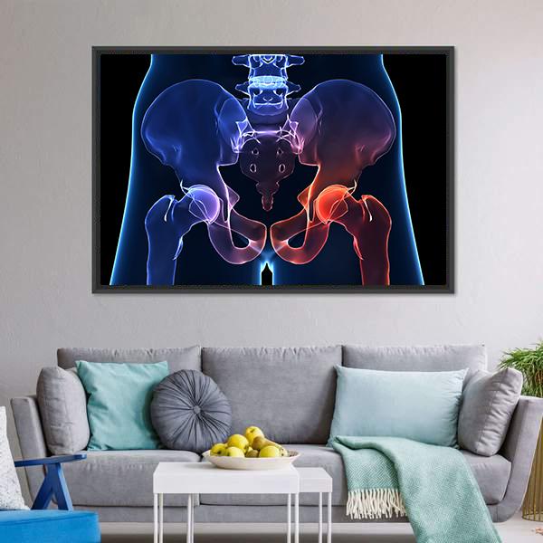 Human Painful Hip Canvas Wall Art-3 Horizontal-Gallery Wrap-25" x 16"-Tiaracle