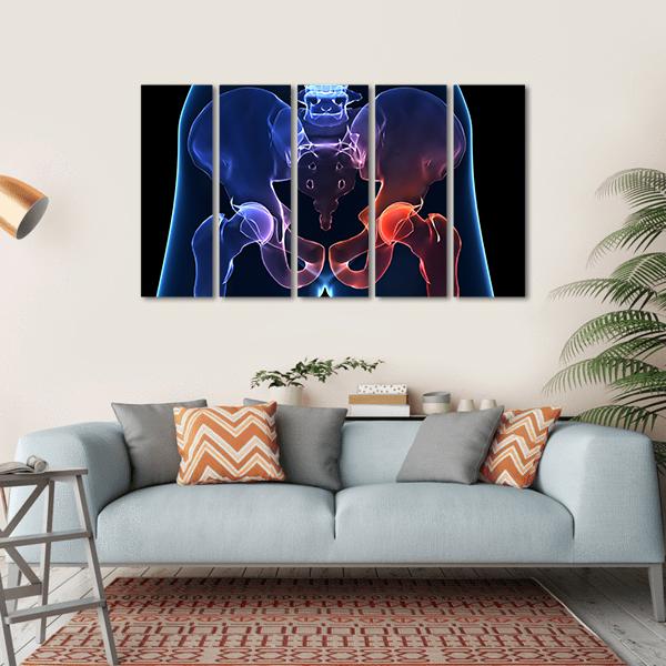 Human Painful Hip Canvas Wall Art-5 Horizontal-Gallery Wrap-22" x 12"-Tiaracle