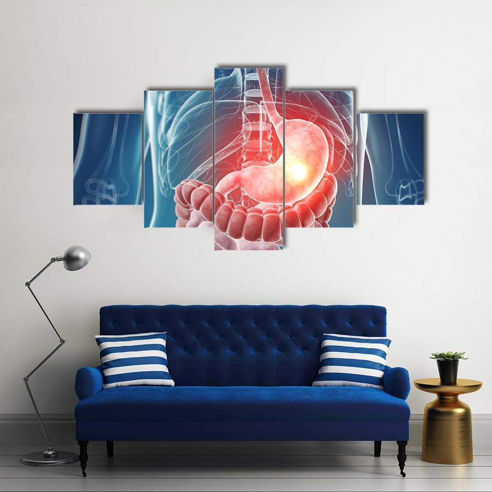 Illustration Of Painful Stomach Canvas Wall Art-5 Star-Gallery Wrap-62" x 32"-Tiaracle
