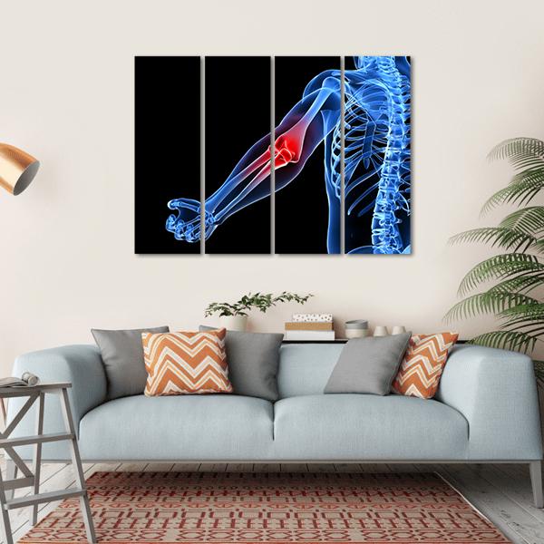 Painful Elbow Illustration Canvas Wall Art-4 Horizontal-Gallery Wrap-34" x 24"-Tiaracle