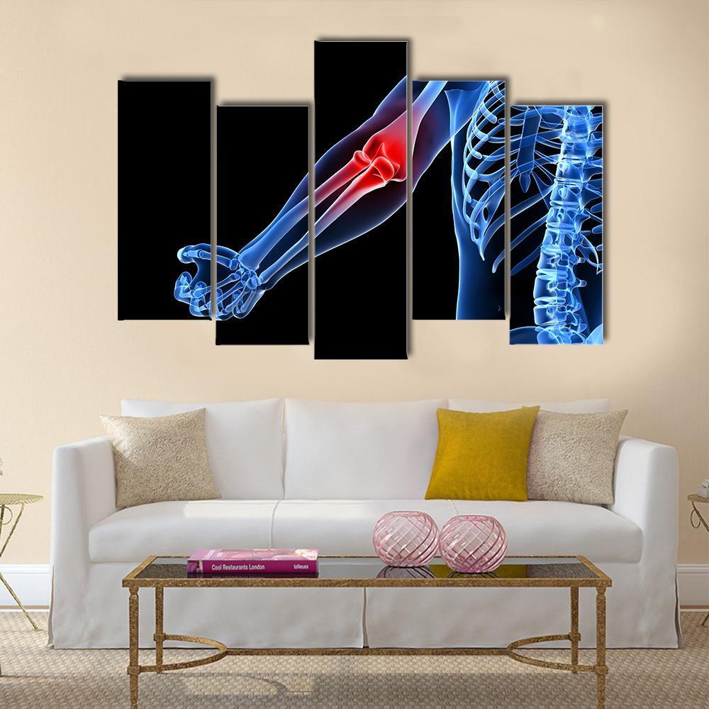 Painful Elbow Illustration Canvas Wall Art-5 Pop-Gallery Wrap-47" x 32"-Tiaracle