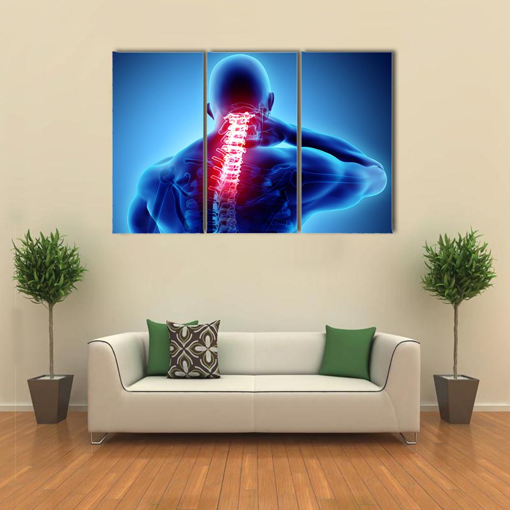 Painful Neck With Cervical Spine Skeleton X-Ray Canvas Wall Art-3 Horizontal-Gallery Wrap-25" x 16"-Tiaracle