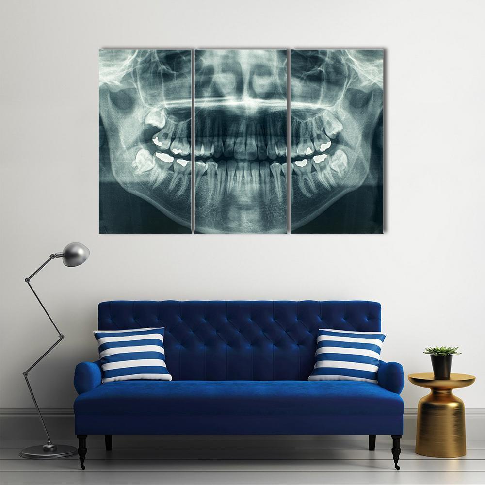 Dental X-Ray Canvas Wall Art-3 Horizontal-Gallery Wrap-37" x 24"-Tiaracle