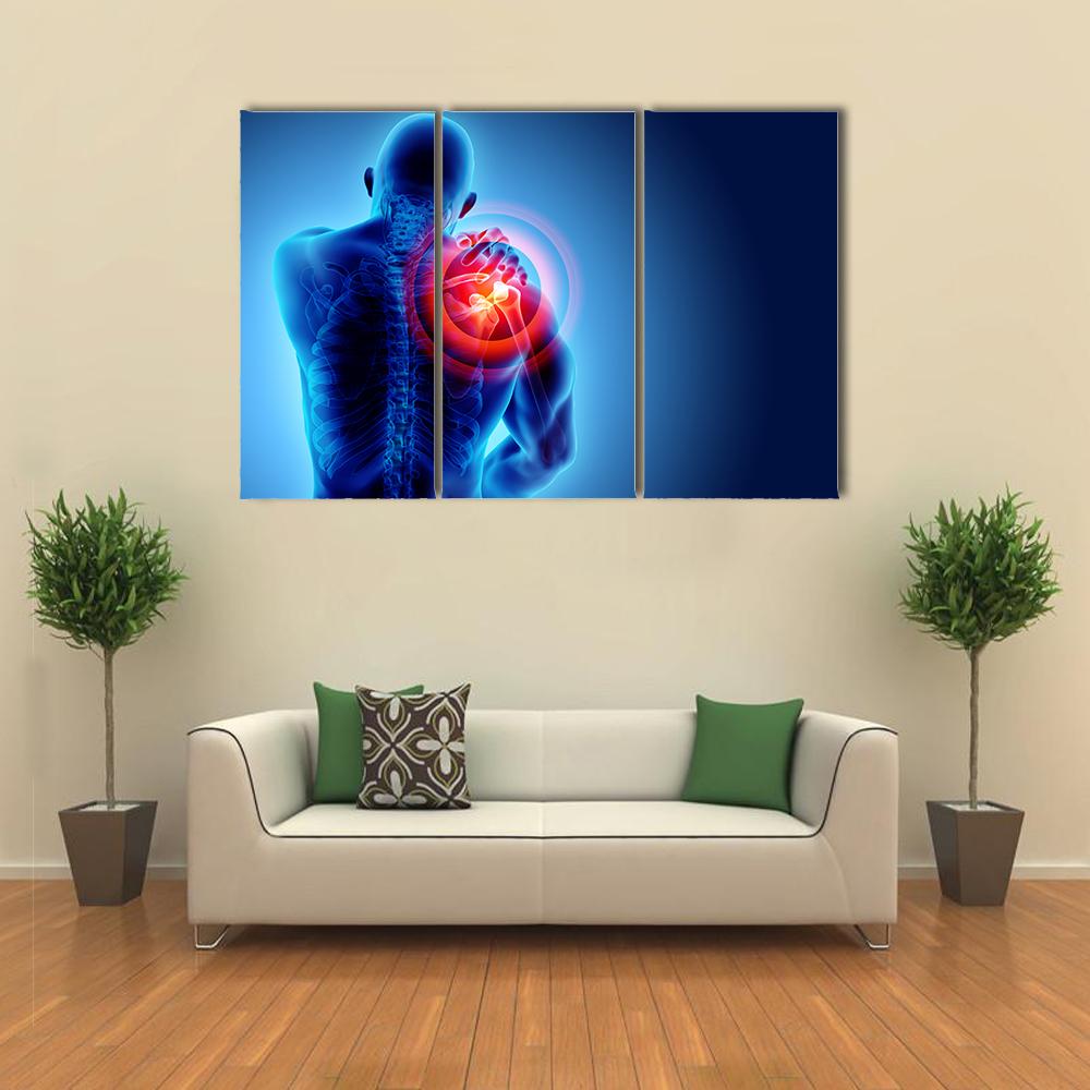 Shoulder Painful Skeleton X-Ray Canvas Wall Art-3 Horizontal-Gallery Wrap-25" x 16"-Tiaracle