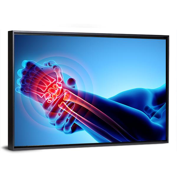 Wrist Painful Skeleton X-Ray Canvas Wall Art-5 Horizontal-Gallery Wrap-22" x 12"-Tiaracle