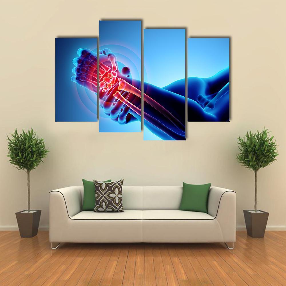 Wrist Painful Skeleton X-Ray Canvas Wall Art-4 Pop-Gallery Wrap-50" x 32"-Tiaracle