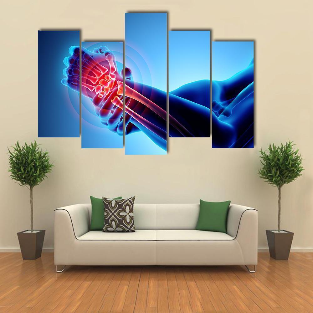 Wrist Painful Skeleton X-Ray Canvas Wall Art-5 Pop-Gallery Wrap-47" x 32"-Tiaracle