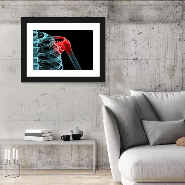 X-Ray Of Painful Shoulder Canvas Wall Art-5 Horizontal-Gallery Wrap-22" x 12"-Tiaracle