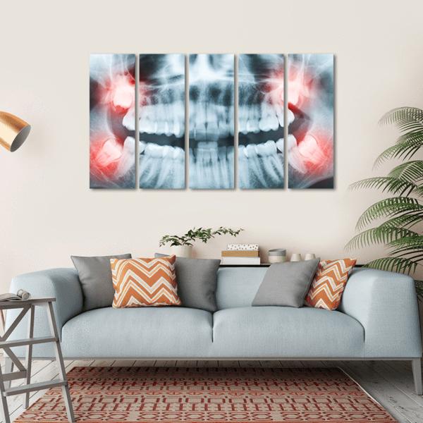 X-Ray Of Teeth And Mouth Canvas Wall Art-5 Horizontal-Gallery Wrap-22" x 12"-Tiaracle