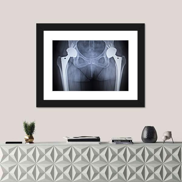 X-Ray Scan Image Of Hip Joints Canvas Wall Art-1 Piece-Framed Print-20" x 16"-Tiaracle