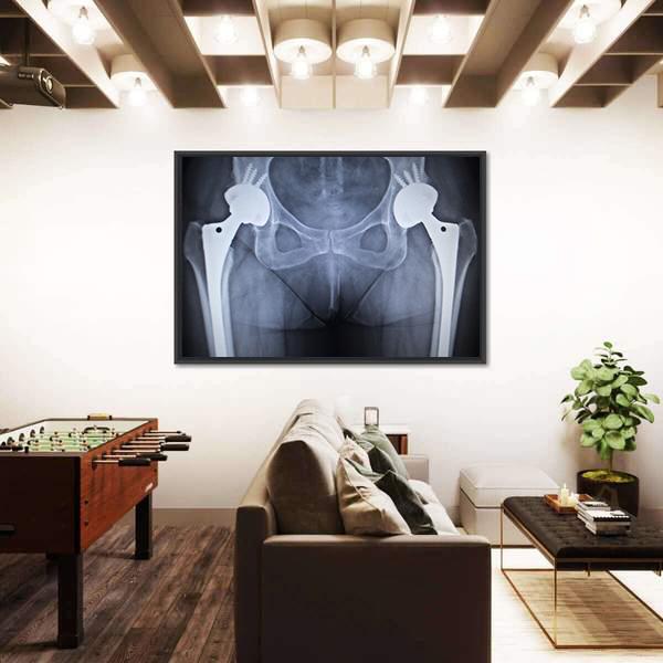 X-Ray Scan Image Of Hip Joints Canvas Wall Art-5 Horizontal-Gallery Wrap-22" x 12"-Tiaracle