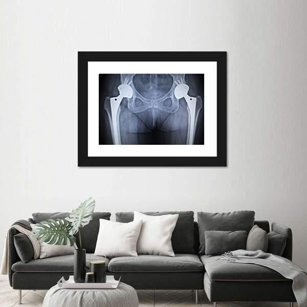 X-Ray Scan Image Of Hip Joints Canvas Wall Art-3 Horizontal-Gallery Wrap-25" x 16"-Tiaracle