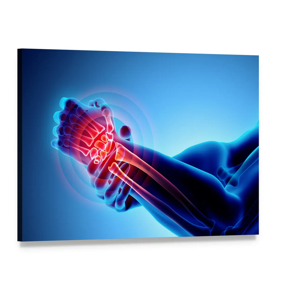 Inflamed Wrist X-ray Illustration Canvas Wall Art, single panel gallery wrapped canvas, angled product view