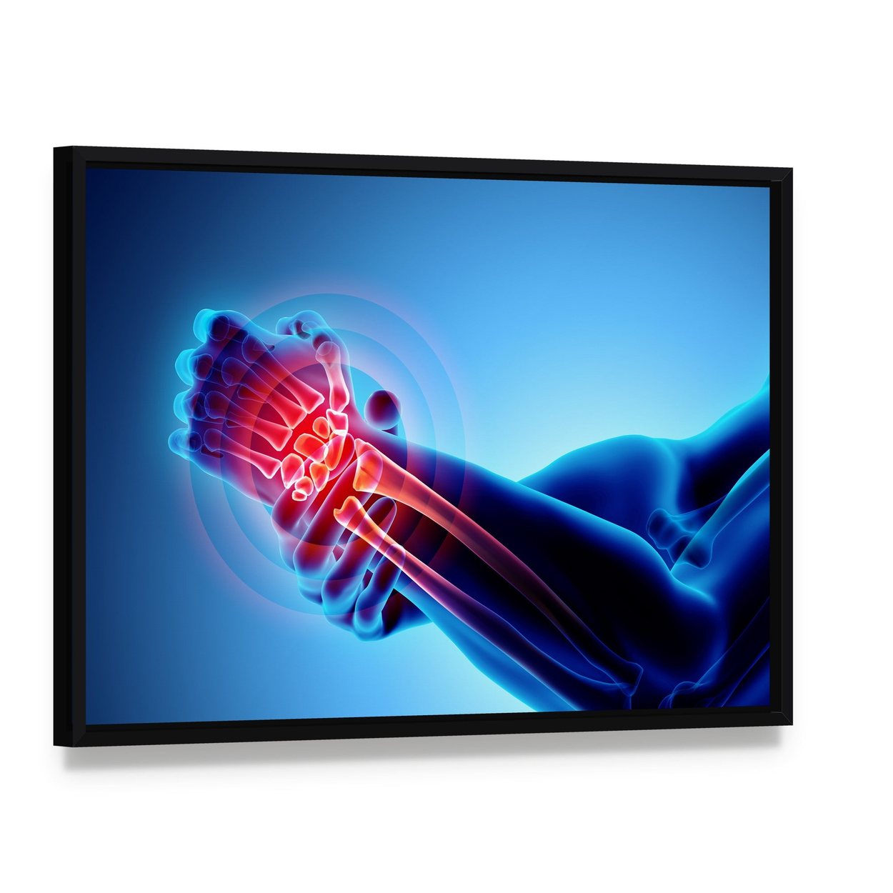 Wrist Pain X-ray Illustration Canvas Wall Art, framed canvas in a black floater frame, angled product view