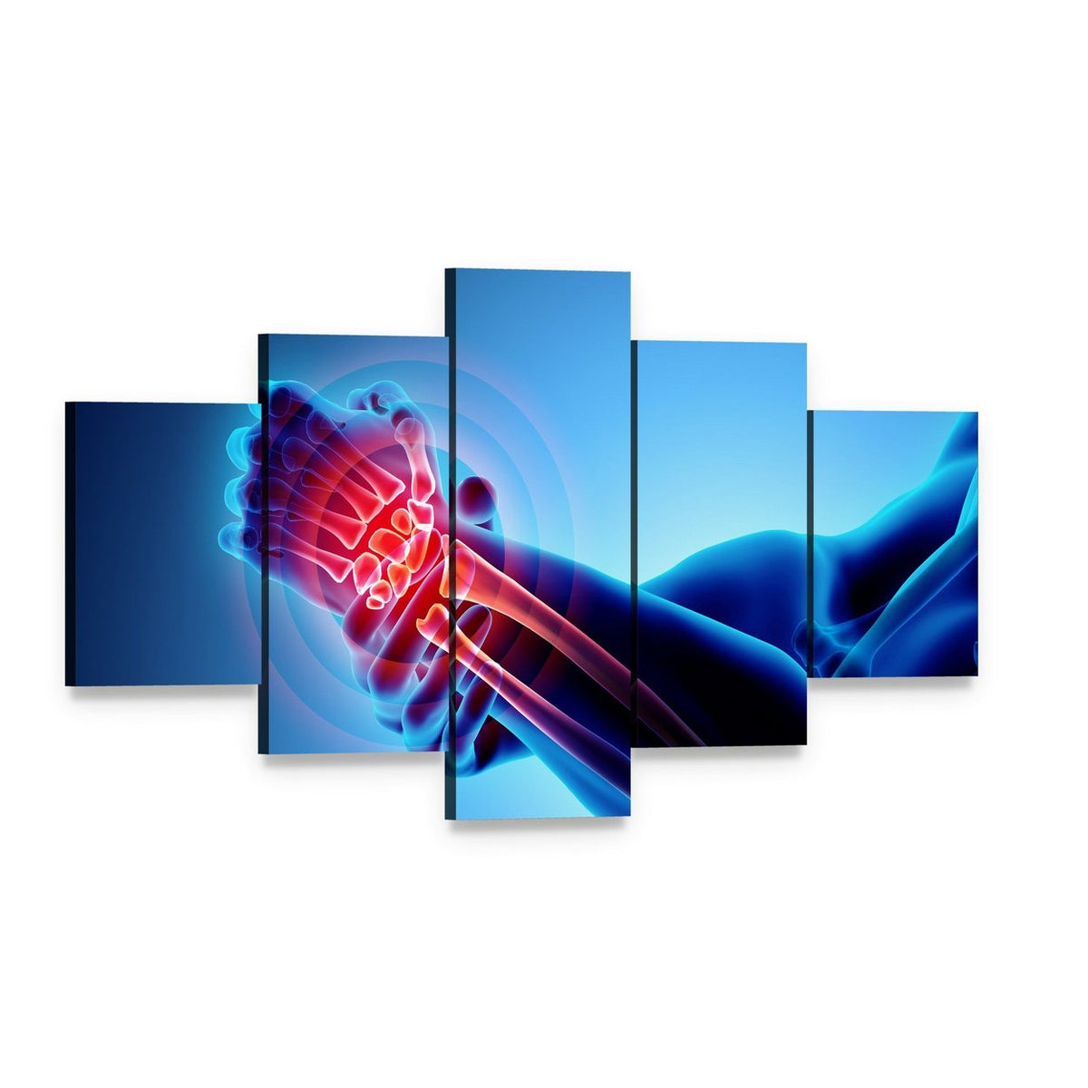 Wrist Pain X-ray Illustration Canvas Wall Art, 5 panel 5 Star layout gallery wrapped canvas set, angled product view
