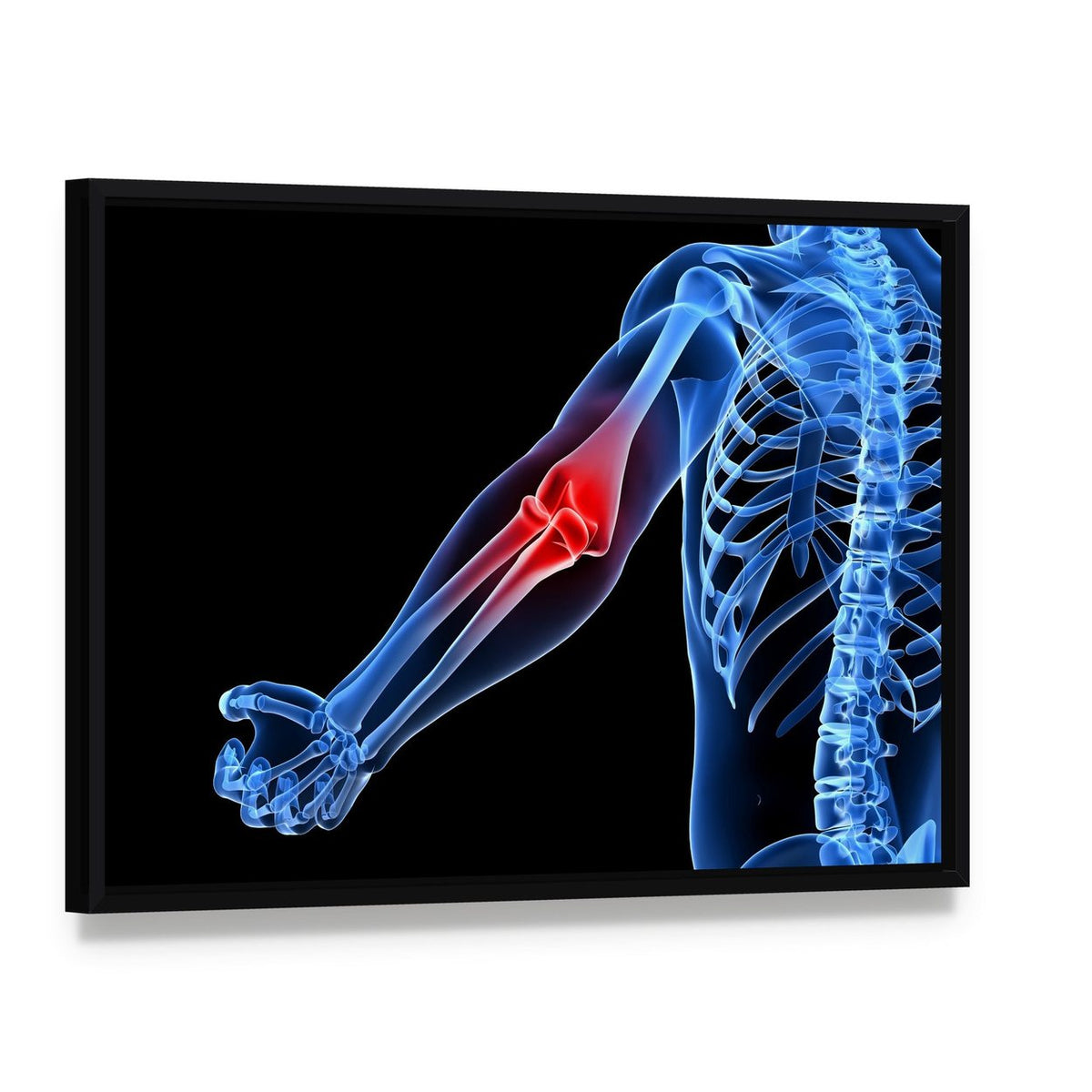 Painful Elbow Medical Illustration Canvas Wall Art, framed canvas in a black floater frame, angled product view