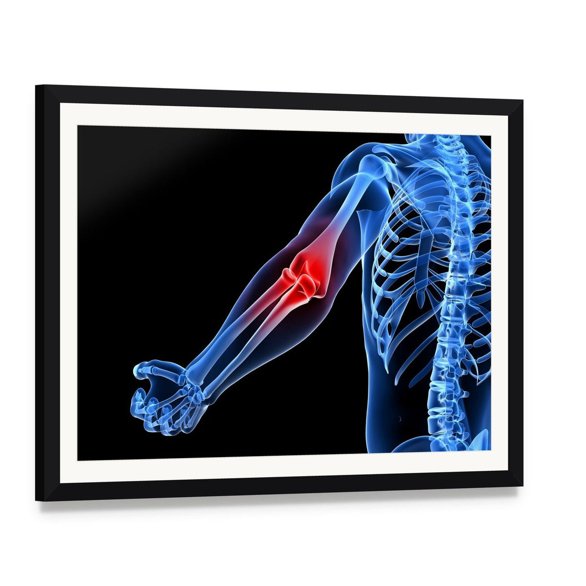 Painful Elbow Medical Illustration Canvas Wall Art, framed print with white mat and black frame, angled product view