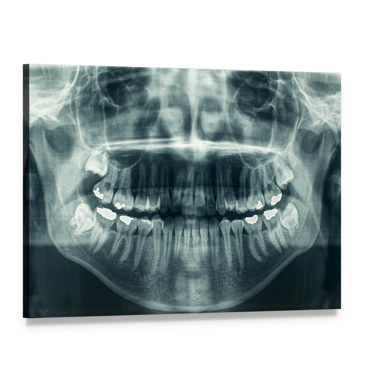 Dental X-ray Canvas Wall Art, single panel gallery wrapped canvas, angled product view
