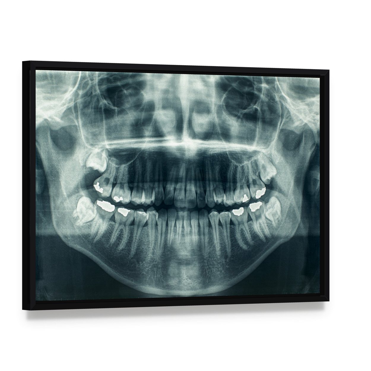 Dental X-ray Canvas Wall Art, framed canvas in a black floater frame, angled product view