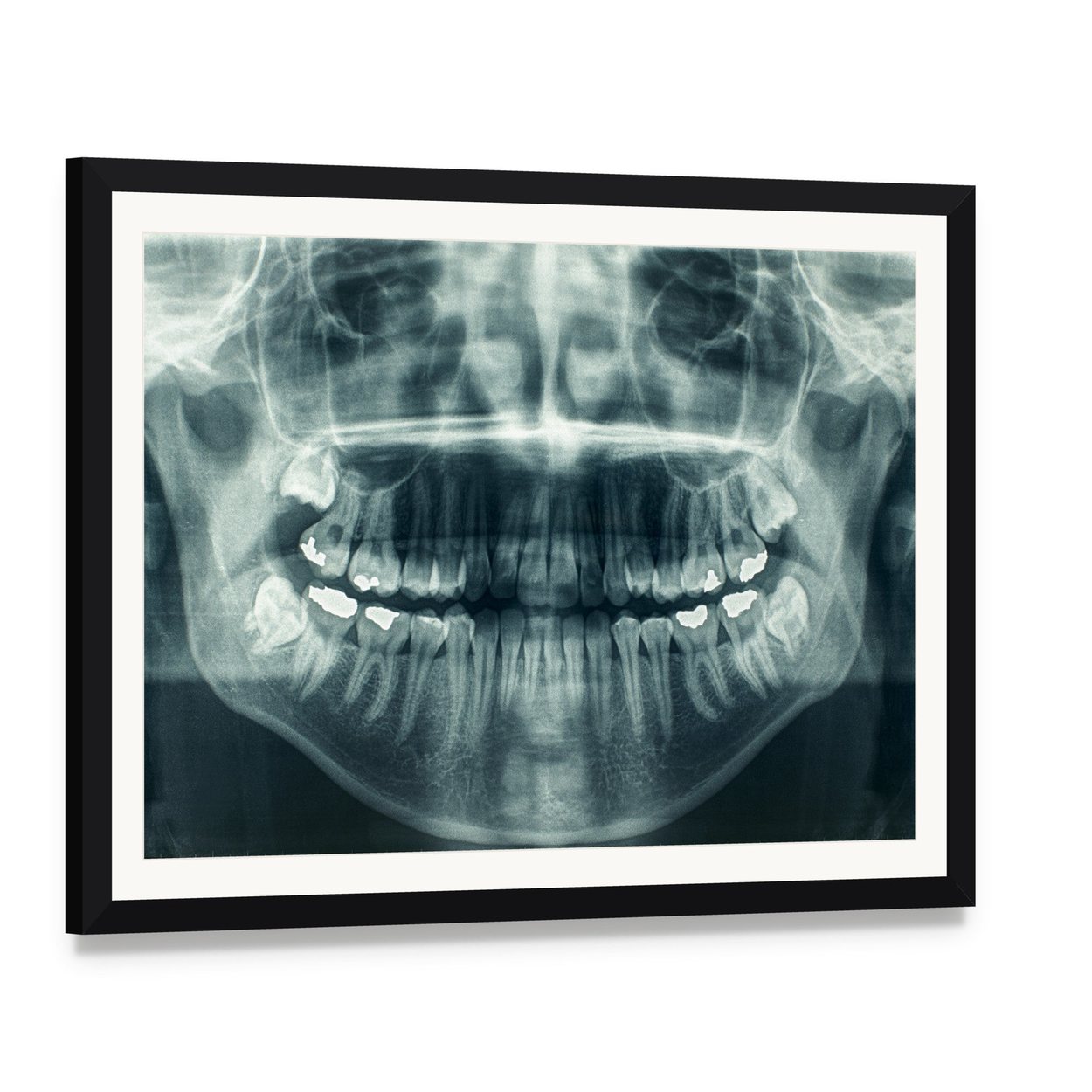 Dental X-ray Canvas Wall Art, framed print with white mat and black frame, angled product view