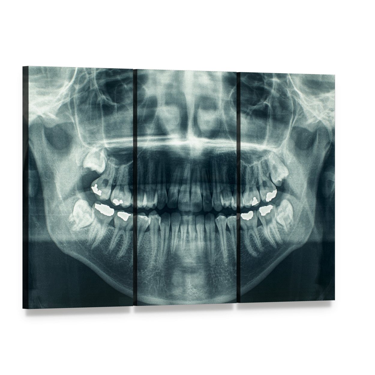 Dental X-ray Canvas Wall Art, 3 panel 3 Horizontal layout gallery wrapped canvas set, angled product view