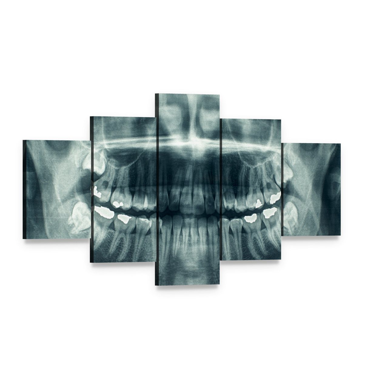 Dental X-ray Canvas Wall Art, 5 panel 5 Star layout gallery wrapped canvas set, angled product view