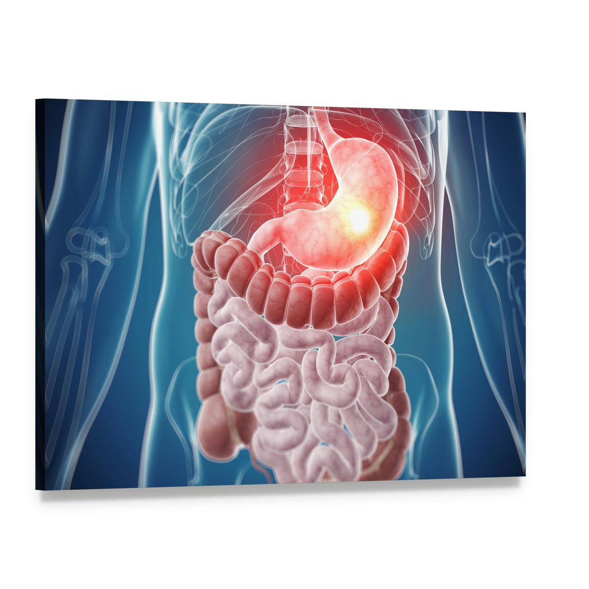 Painful Stomach Anatomical Illustration Canvas Wall Art, single panel gallery wrapped canvas, angled product view