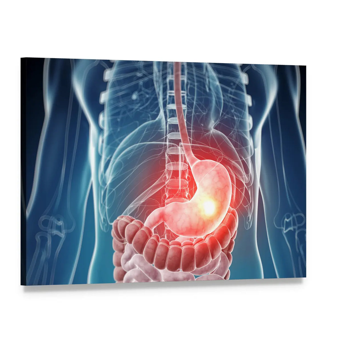 Painful Stomach Anatomical Illustration Canvas Wall Art, single panel gallery wrapped canvas, angled product view