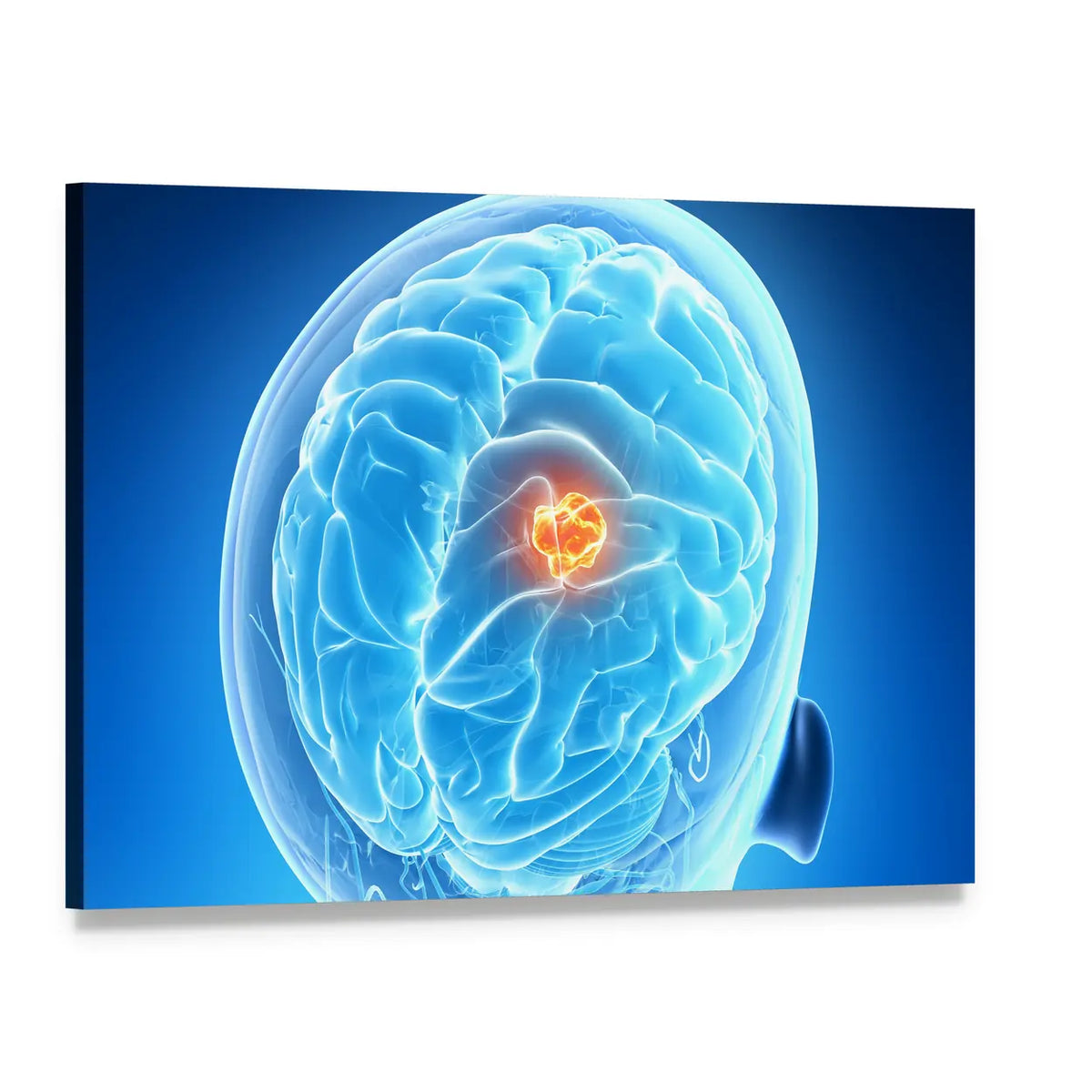 Brain Tumor Illustration Canvas Wall Art, single panel gallery wrapped canvas, angled product view